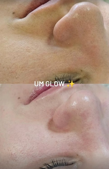 Antes e depois do tratamento facial